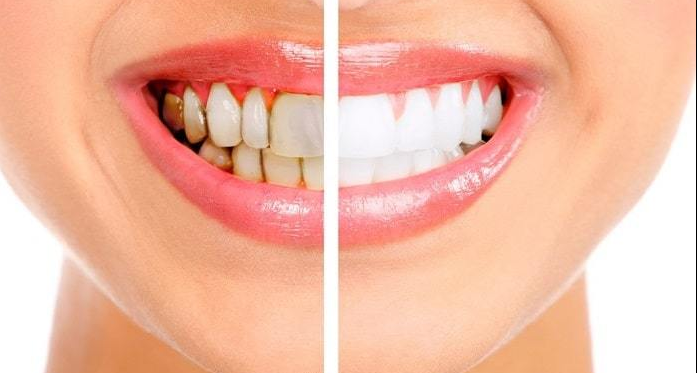 Dental Teeth Whitening