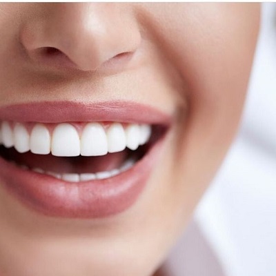 Everything You Need to Know About Teeth Whitening