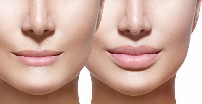 Restylane vs. Juvederm