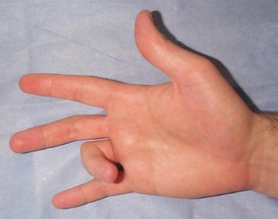 natural ways to cure trigger fingers