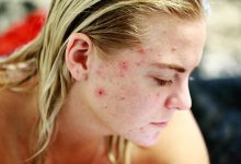 Photo of Treatments For Acne Scars